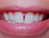 علاج الفروق بين الأسنان بالحشوات التجميلية أو التركيب