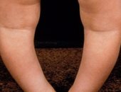 ما هو مرض تقوس الساقين "بلونت" عند الأطفال؟
