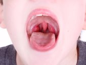 الاختناق أثناء النوم أخطر أعراض التهاب اللوزتين عند الأطفال