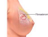 "أورام ليفية وغدد لبنية" أمراض أخرى تصيب الثدى.. مش شرط يكون سرطان