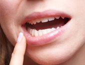 صحة أسنانك مش رفاهية.. التهاب اللثة يسبب الإصابة بالسكر وهشاشة العظام 