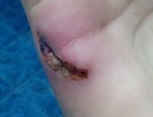 بالصور.. كلب يعقر سيدة بالعمرانية.. وتستغيث : ارحمونا من الكلاب الضالة