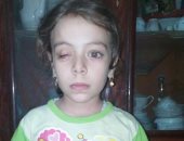 مادة كيميائية أفقدت الطفلة "نور" بصرها.. ووالدها يطالب بعلاجها