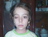 بالصور.. مأساة الطفلة "نور" فقدت عينها بسبب الكلور: نفسى أشوف تانى 