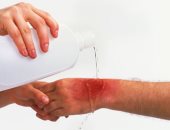 علاج الحروق الناتجة عن المياه المغلية وطرق اسعافها سريعا 