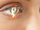 تعرف على أبرز 7 فحوصات قبل الخضوع لعملية الليزك.. فحص حدقة العين أهمها 