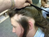 التعايش مع الأمراض المناعية.. كيف يمكن التعامل مع أعراض مرض الذئبة