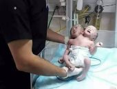 ولادة طفلين توأم برأسين وجسد واحد فى قطاع غزة
