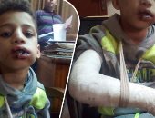 أب يعذب طفليه ويصيبهما بكسور وجروح بحجة تأديبهما بالسنطة "صور" 