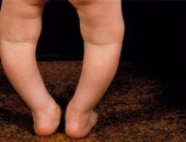 تعرفى على أسباب إجراء تحليل نقص الكالسيوم للأطفال