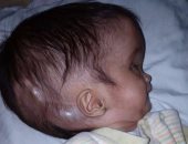 "كل الحدوتة علاج بنوتة".. "سجدة" تعانى من ضمور بالمخ وتضخم الجمجمة.. "أبو الريش" يرفض استقبالها.. الأب: "عاوز  أعرف بنتى ليها علاج ولا هتموت".. ومدير المستشفى "لا حياة لمن تنادى"