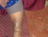 صور.. مرض الفيل يلازم الحاجة فاطمة 15سنة.. وتؤكد: "نفسى فى دكتور ابن حلال"