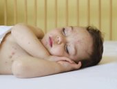 طرق علاج الطفح الجلدى عند الأطفال.. منها عدم التعرض للشمس