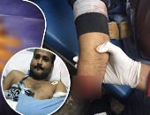 صور.. "لأول مرة فى مصر".. مستشفى الطوارئ بجامعة المنصورة تنجح فى توصيل كف يد "مبتورة".. المريض خضع لجراحة ميكروسكوبية دقيقة استغرقت 9 ساعات.. فريق طبى متخصص أعاد توصيل الشرايين والعظام والأعصاب