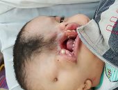 صور.. طفل يعانى من مرض نادر يحتاج لعلاج خارج مصر