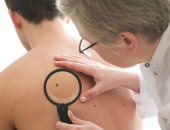 دراسة: بعض عقاقير التهاب المفاصل قد تشكل أملا فى علاج سرطان الجلد