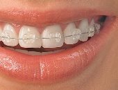 شفاف ومعدنى وجراحى.. تعرف على أنوع تقويم الأسنان