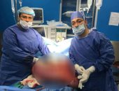 صور.. استئصال أضحم قولون لمريضة بمعهد أورام دمنهور