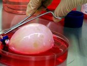 لو مريض سرطان المثانة.. خاف على نفسك من تكون الجلطات واعرف تتعامل ازاى