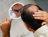 الصلع عند الذكور مقابل فقدان الشعر عند الإناث أسباب صحية اعرفها