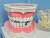 ماهى الحالات التى تستدعى تركيب طقم الأسنان؟