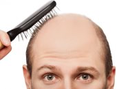علاج الصلع الوراثى.. كيف يمكن التغلب على فراغات الشعر؟