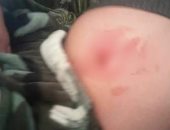 صور.. "صحة الدقهلية" تعلن اكتشاف حالتين نادرتين لمرض العرق الدموى