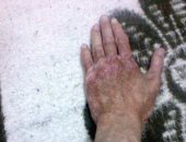 صور.. قارئ مصاب بمرض جلدى يستغيث: "ما حدش راضى يشغلنى وأنا محتاج أدوية"