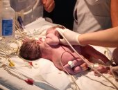 أول حالة ولادة لتوأم ملتصق البطن والصدر بمستشفى الأطفال بجامعة المنصورة