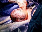 ديلى ميل: ولادة طفلة أمريكية بداخل كيس الغشاء الأمنيوسى فى حالة نادرة.. صور