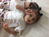 صور.. جامعة المنصورة تستجيب لطلب والد بفصل طفلتيه الملتصقتين من الرأس