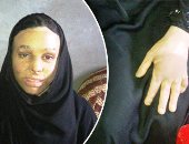 صور وفيديو.. "سمية" أجرت 18 عملية بسبب حرق فى وجهها لوزير الصحة: "نفسى أتعالج"