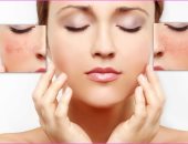 استخدم الطب البديل لعلاج احمرار الوجه بأقنعة الخيار والشوفان
