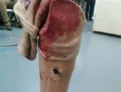 مصاب فلسطينى بمسيرة العودة: جنود الاحتلال اطلقوا الرصاص على ساقى الصناعية