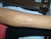 صور.. شاب من السويس يروى تفاصيل نجاته من لعبة الحوت الأزرق