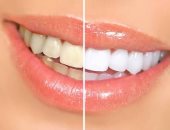 تبييض الأسنان بطريقة طبيعية.. 8 طرق سهلة بينها الفراولة والليمون
