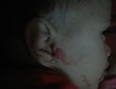 صور.. طفلة تنزف دما بالدقهلية من فتحات جسمها.. والأطباء: مرض مجهول