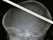 صور.. أطباء جامعة طنطا ينقذون طفل بعد اختراق سيخ حديد رأسه