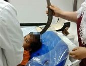فريق طبى ينجح فى إنقاذ حياة طفل دخل فى رأسه "منجل" زراعى بدمياط