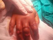 صور.. مدير مستشفى طوارئ المنصورة يشرح كيف أنقذ الأطباء فتاة من قطع يدها؟