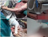 صور.. أطباء مستشفى دمياط التخصصى ينقذون ذراع عامل تعرضت للهرس خلال تنظيفه ماكينة أخشاب.. الطبيب المعالج: الجراحة استمرت 4 ساعات ونصف لتثبيت الذراع وتوصيل الشرايين واستعادة الدورة الدموية وحالة المريض مستقرة