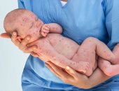 الرضع تنخفض مقاومتهم للحصبة بعمر 3 أشهر وتنتهى فى الشهر السادس.. دراسة تؤكد