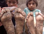 مأساة أسرة باكستانية.. تحول أرجل أطفال إلى حجارة بسبب مرض نادر.. صور