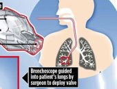FDA توافق على جهاز جديد لعلاج صعوبة التنفس المرتبطة بانتفاخ الرئة