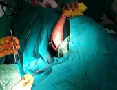 صور.. ﻷول مرة إجراء جراحة إصلاح تشوهات عظام اﻷطفال بمستشفى أبورديس المركزى