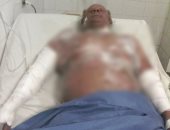 مدرب كمال أجسام بالسويس يشعل النار فى نفسه بسبب خلاف مع إدارة مركز شباب