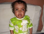 فيديو وصور.. مأساة الطفلة "كارما" بقنا.. تعانى من مرض جلدى نادر