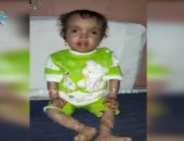 استجابة لـ"اليوم السابع".. هانى الناظر يتبنى حالة الطفلة كارما المصابة بمرض جلدى نادر