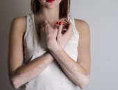 هل تناول طعام مر عليه برص يتسبب فى الإصابة بالبهاق ؟