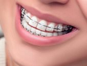 بـ 3 خطوات بسيطة.. اعرف ازاى تنظف تقويم الأسنان